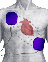 Defibrillering